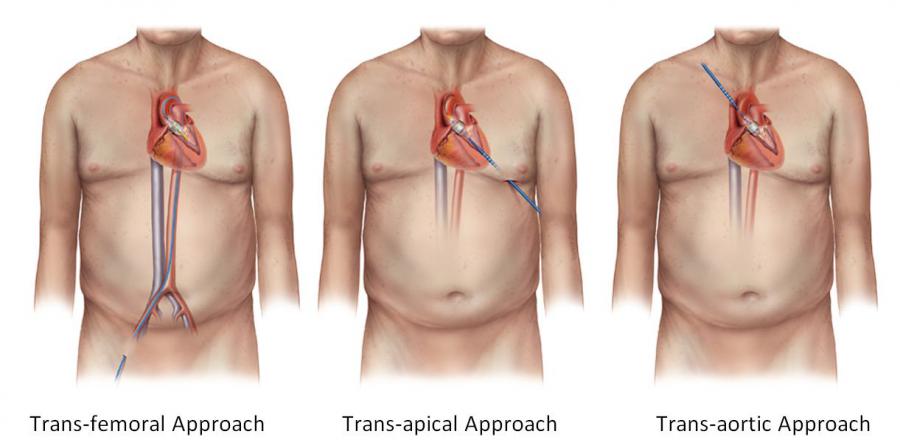 Transcatheter Aortic Valve Replacement System Market