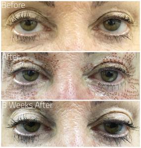 Plasma Pen Pro Eyebrow Lift and Eyelift Before and After Results