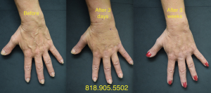 Before, after three days and 3-4 weeks later